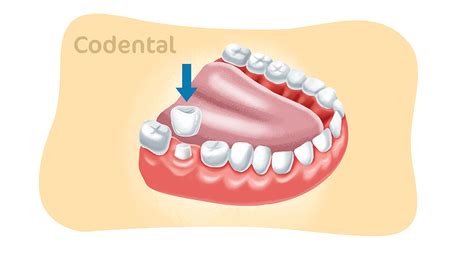 coroas fio dental|Coroa dentária: 6 principais tipos que você precisa conhecer!